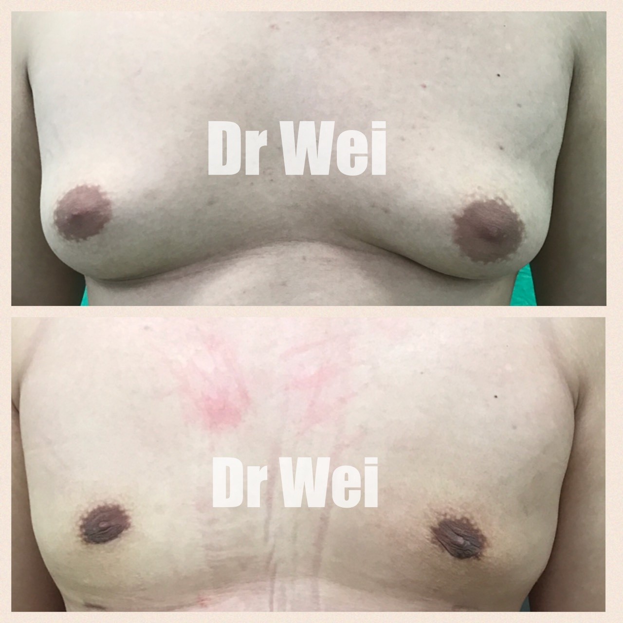 高雄男性女乳治療案例