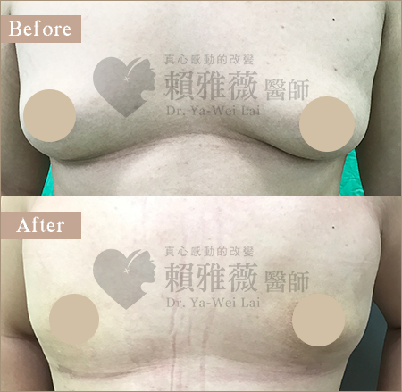 男性女乳案例