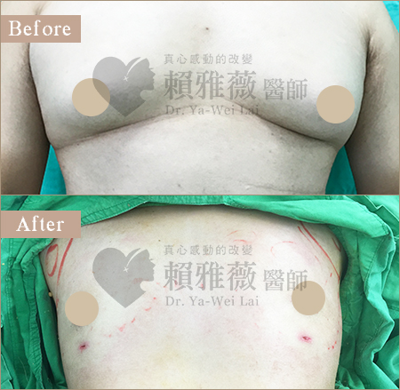 男性女乳案例