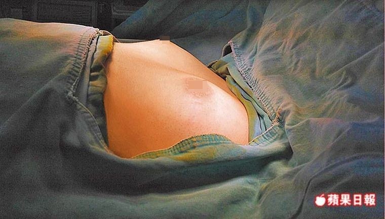 男性女乳症成因多　勤健身也練不出大肌肌